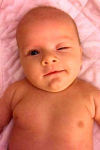 ptose palpebral congênita em bebê